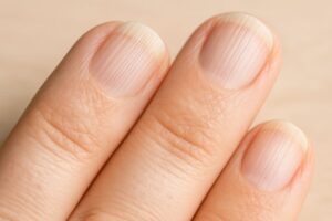 stries sur les ongles